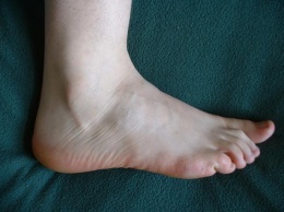 Meдики: Боль в ногах при ходьбе может указывать на заболевание периферических артерий