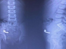 В Югре хирурги достали магнитные ширики из желудка годовалого ребенка
