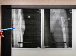Об уникальной методике лечения ортопедической патологии коленного сустава рассказали алтайские медики