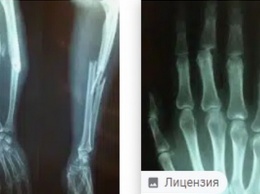 Сибирские ученые вдвое ускорили восстановление костей при переломах