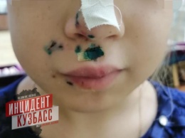 Стая чипированных собак в Кузбассе покусала девочку за лицо