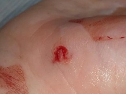 В Балакове бездомная собака укусила девочку за руку
