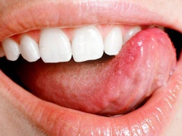 Медики назвали причины опухлости языка