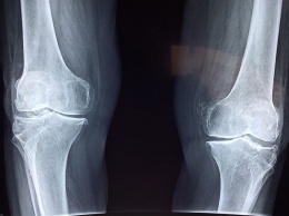 Хирурги перепутали ноги пожилой британки при установке коленного имплантата