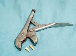 Британец плоскогубцами вырвал себе зубы из-за пандемии коронавируса