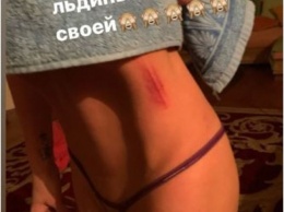 Купавшаяся в ледяной купели "голая" Волочкова получила травму