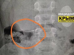 В симферопольской больнице спасли ребенка, который проглотил иглу на приеме у стоматолога, - источник