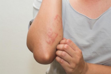 Сухая кожа может быть симптомом аллергии, диабета и рака