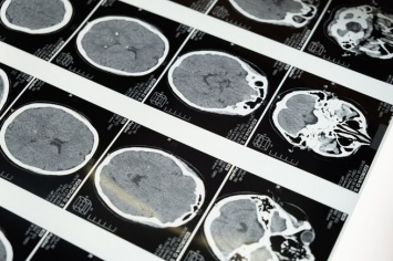 Российский медик дал советы по восстановлению работы мозга после COVID-19