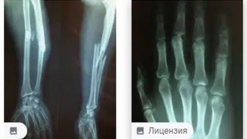 Сибирские ученые вдвое ускорили восстановление костей при переломах