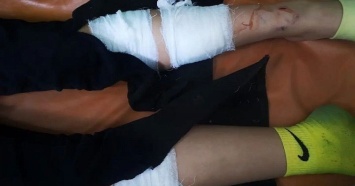 Раны на ногах и руках: в районе парка «Краснодар» свора собак напала на 11-летнюю девочку