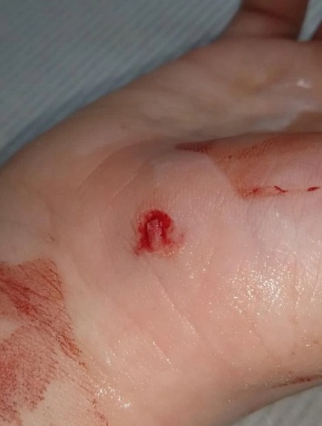 В Балакове бездомная собака укусила девочку за руку