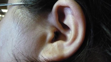 Врачи назвали причину появления шума в ушах