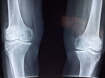 Хирурги перепутали ноги пожилой британки при установке коленного имплантата