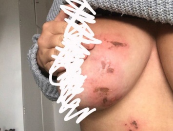 Англичанка опубликовала фото голой обожженной кроп-топом груди