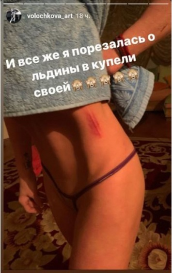 Купавшаяся в ледяной купели "голая" Волочкова получила травму